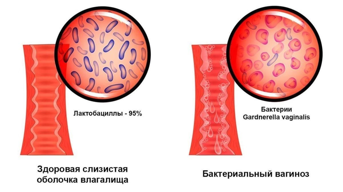 Баквагиноз что это