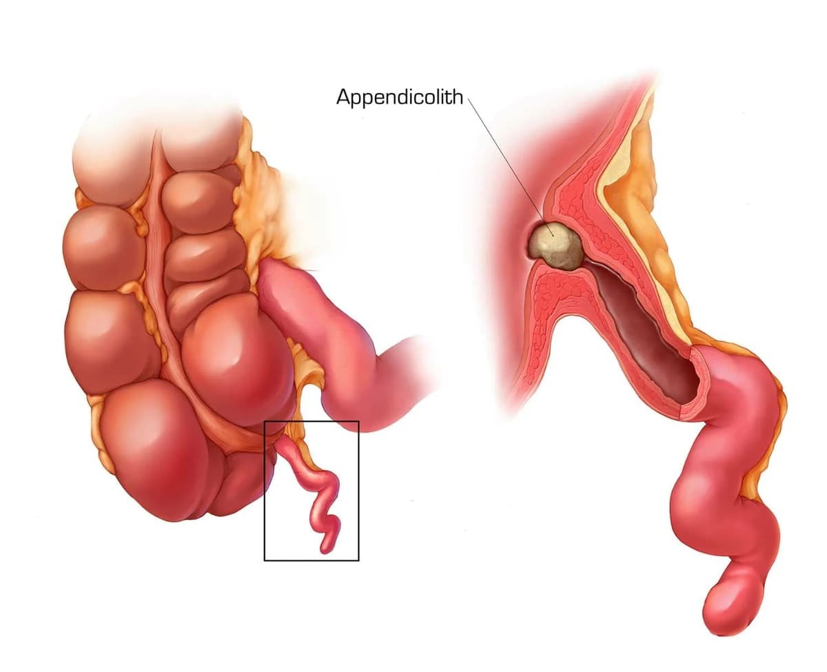 chto-takoe-appendiczit-rannie-simptomy-prichiny-lokalizacziya-boli-hirurgicheskoe-vmeshatelstvo