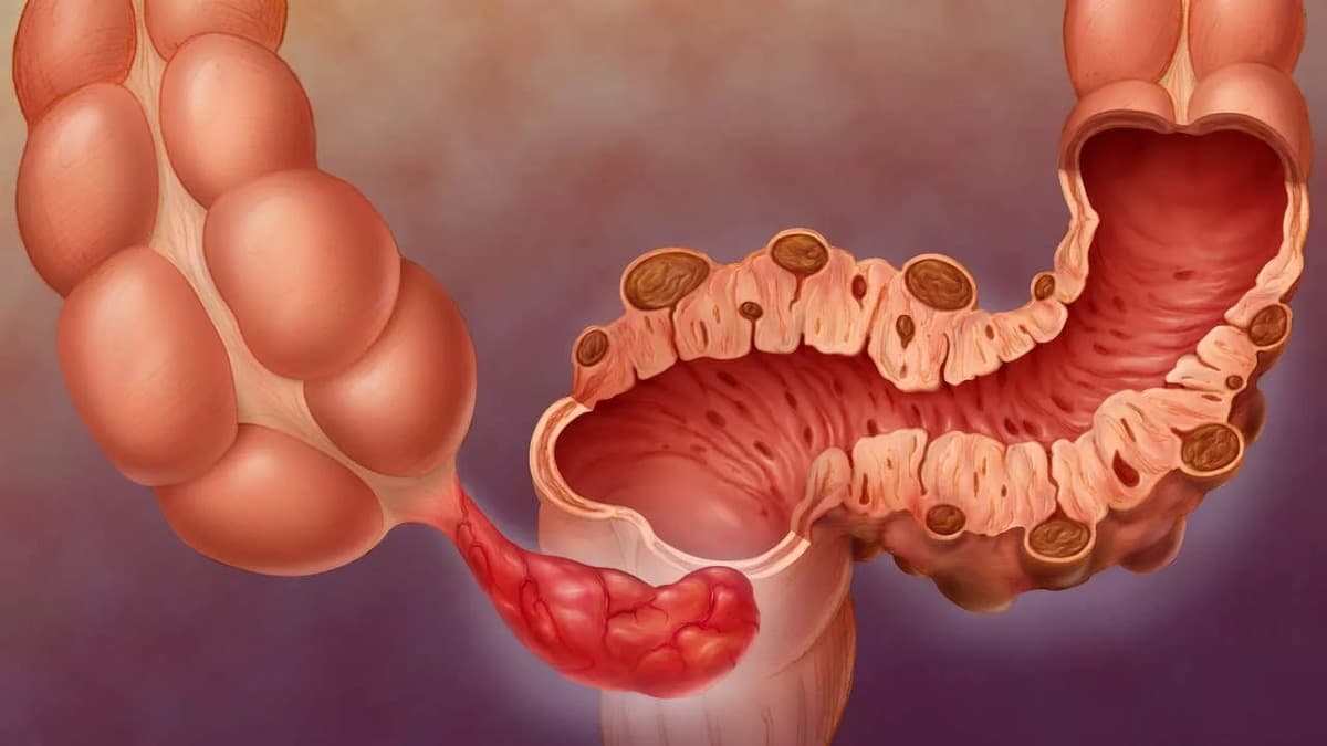 chto-takoe-divertikulit-simptomy-prichiny-diagnostika-i-lechenie