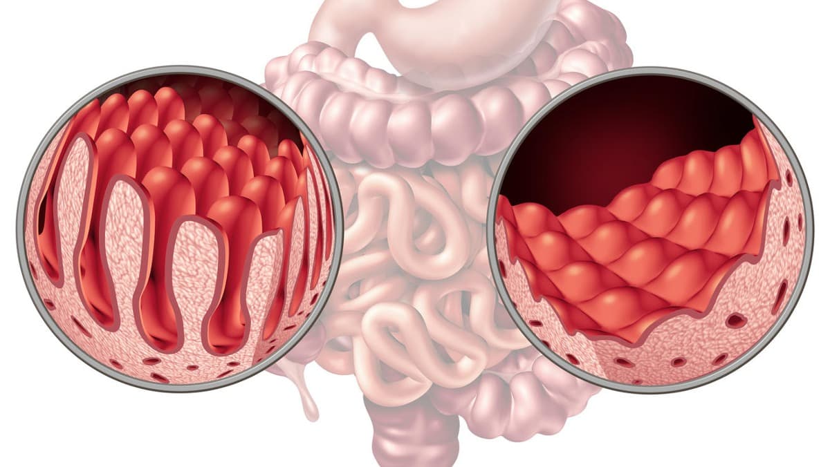 chto-takoe-enteropatiya-s-poterej-belka-simptomy-prichiny-metody-lecheniya