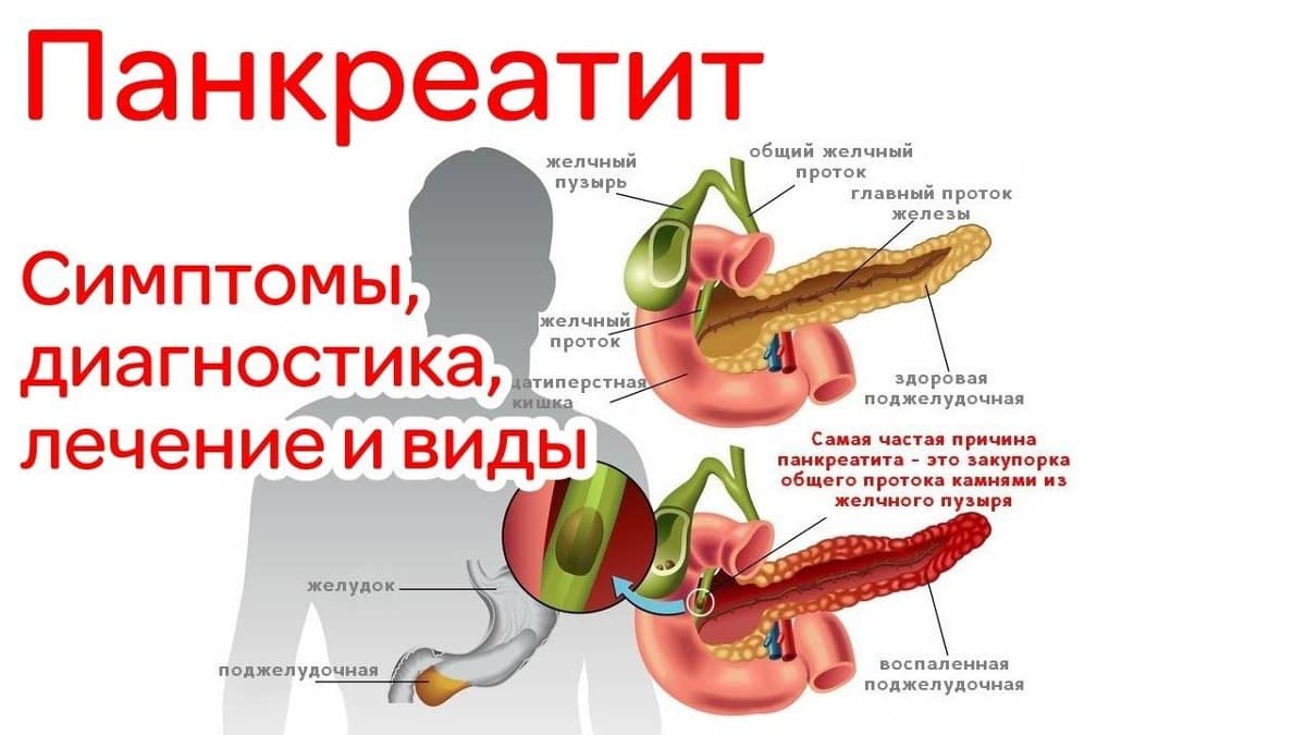 chto-takoe-pankreatit-simptomy-diagnostika-testy-lechenie-faktory-riska