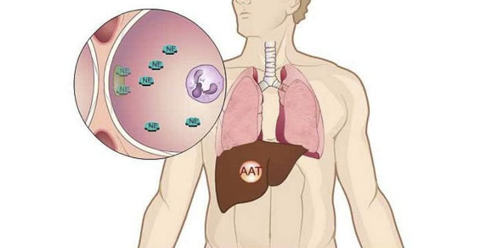 deficzit-alfa-1-antitripsina-nachinaetsya-v-pecheni