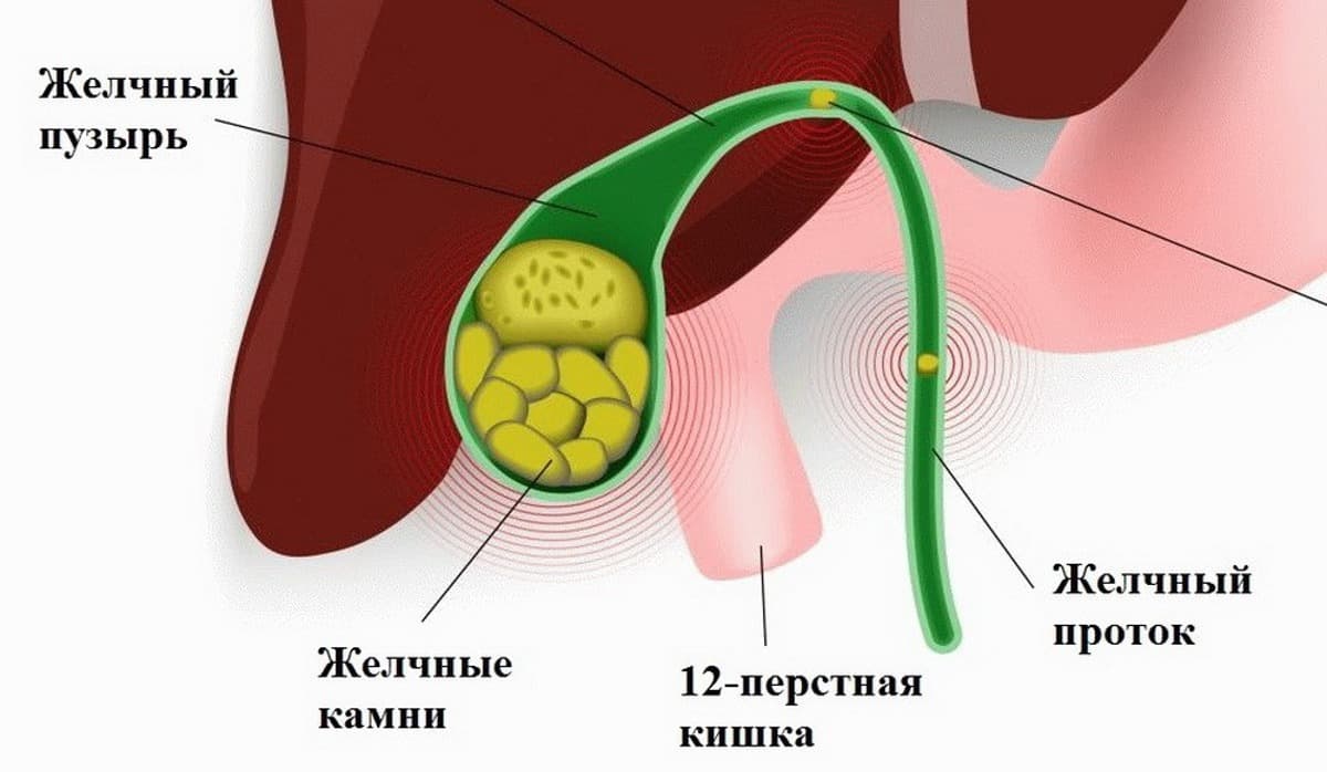 kamni-v-zhelchnom-puzyre-prichiny-simptomy-vidy-metody-lecheniya