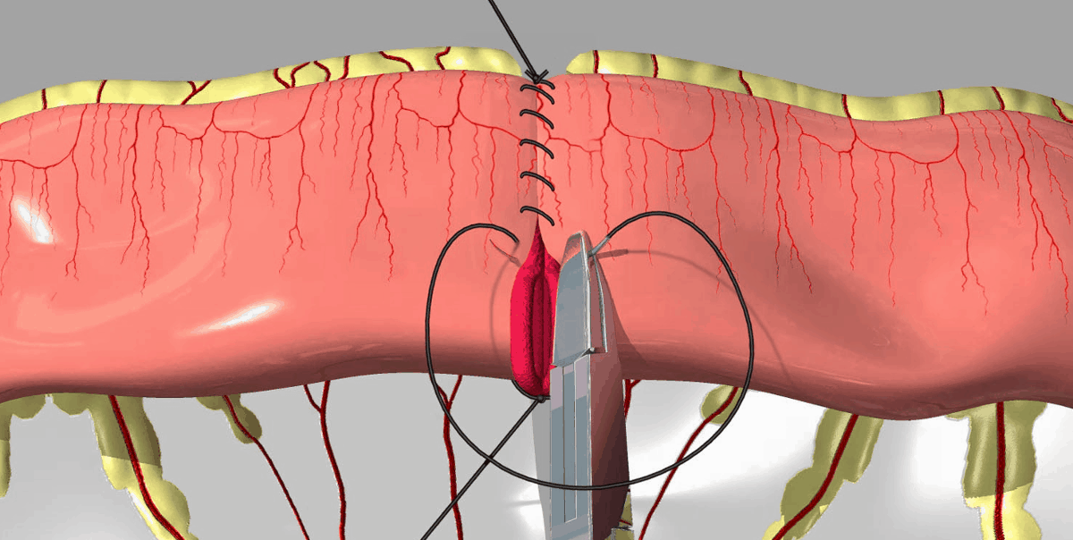 nesostoyatelnost-anastomoza-prichiny-simptomy-sposoby-lecheniya