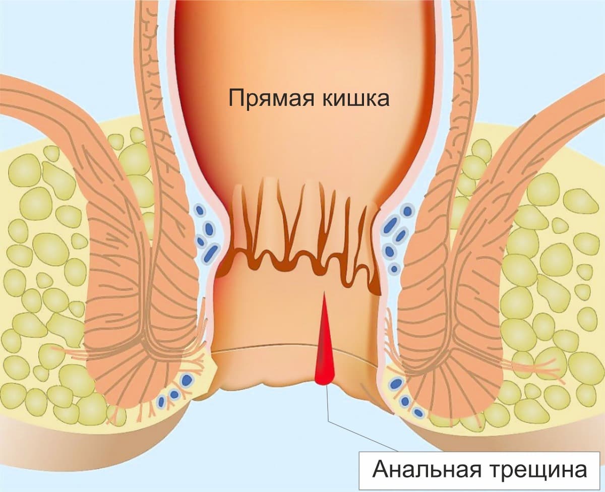 simptomy-analnoj-treshhiny-priznaki-togo-chto-treshhina-stala-hronicheskoj