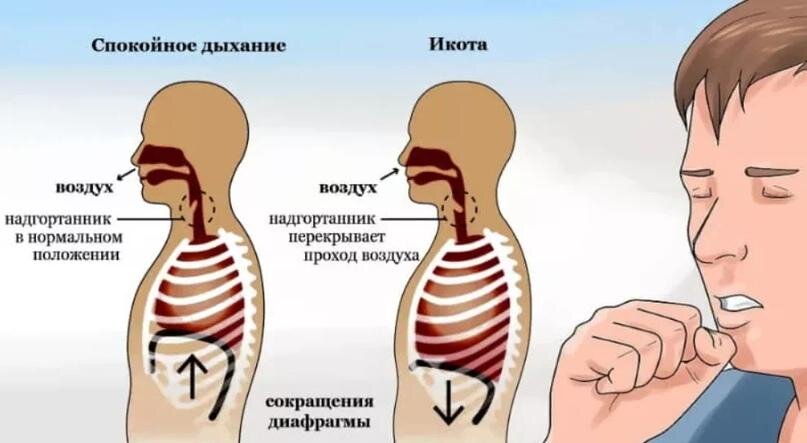 Как быстро избавиться от икоты