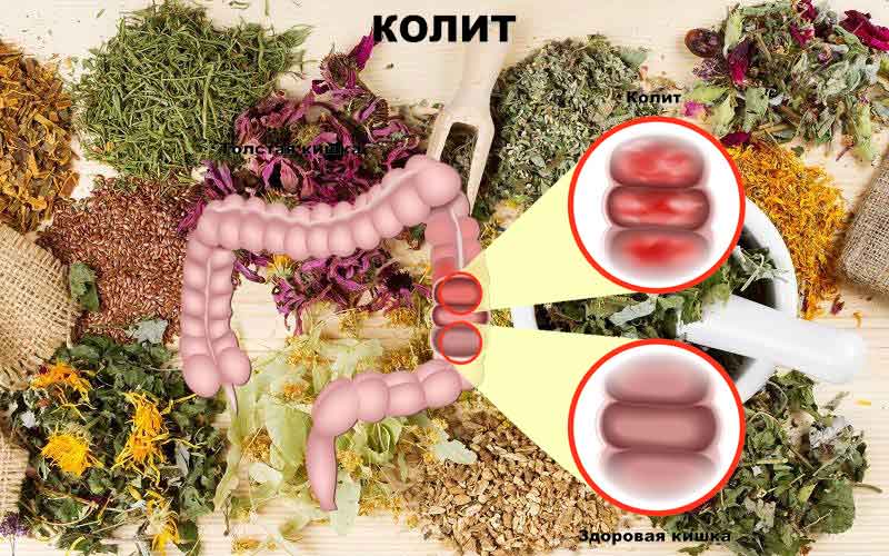 Лечение язвенного колита народными средствами