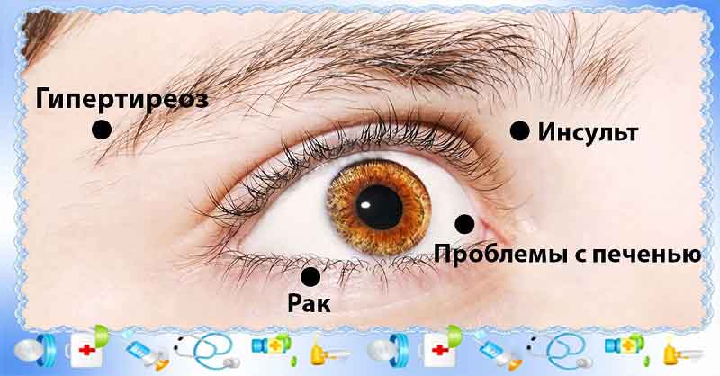 Какие можно болезни определить по глазам