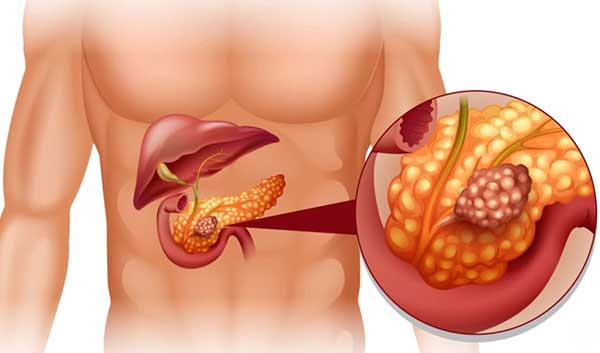 Киста поджелудочной железы. Что это такое и как лечить