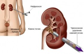 Лечение почечных камней