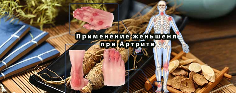 Применение женьшеня при Артрите