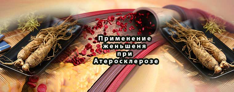 Применение женьшеня при Атеросклерозе